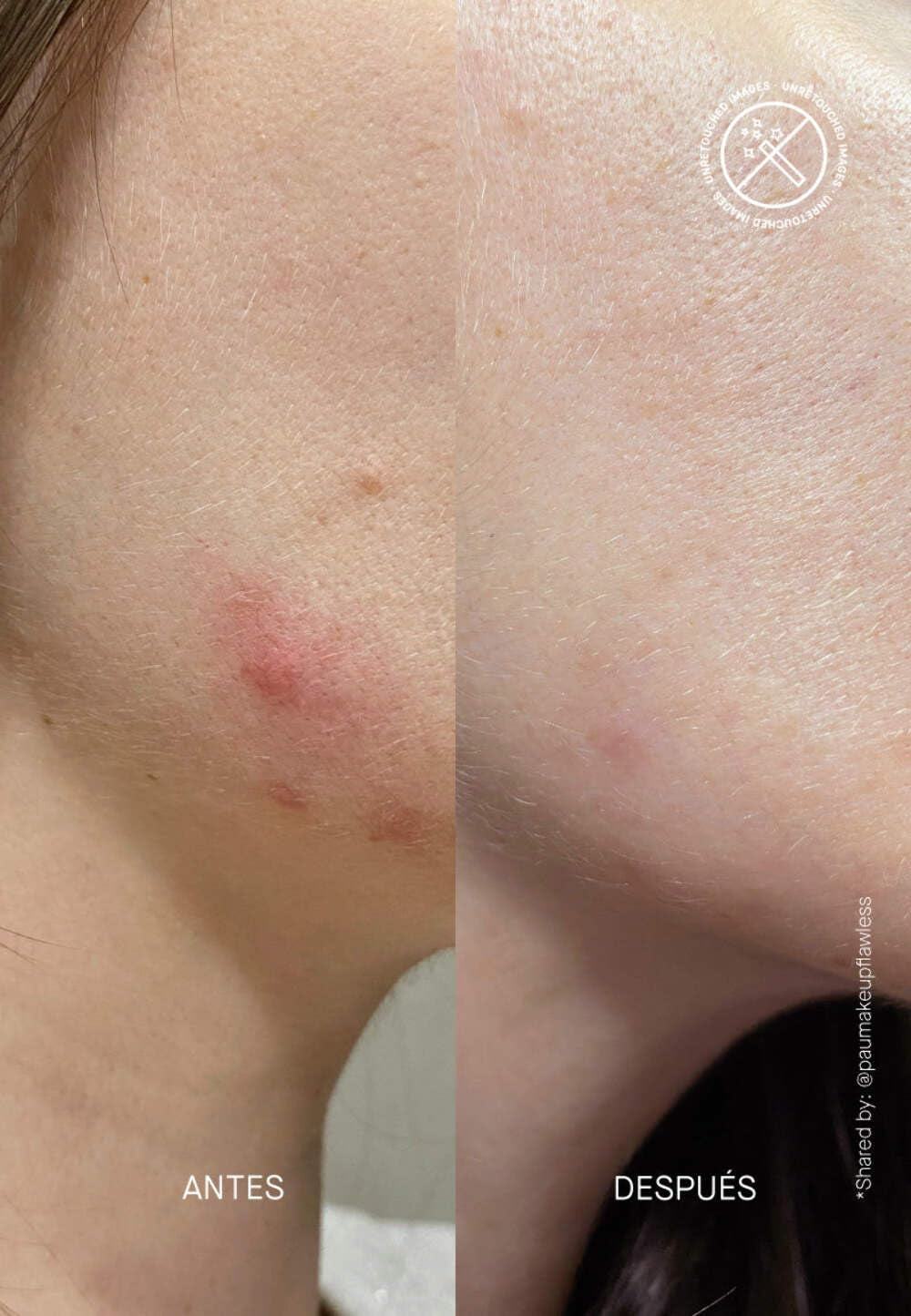 POSTZIT® - Zit Marks Solution