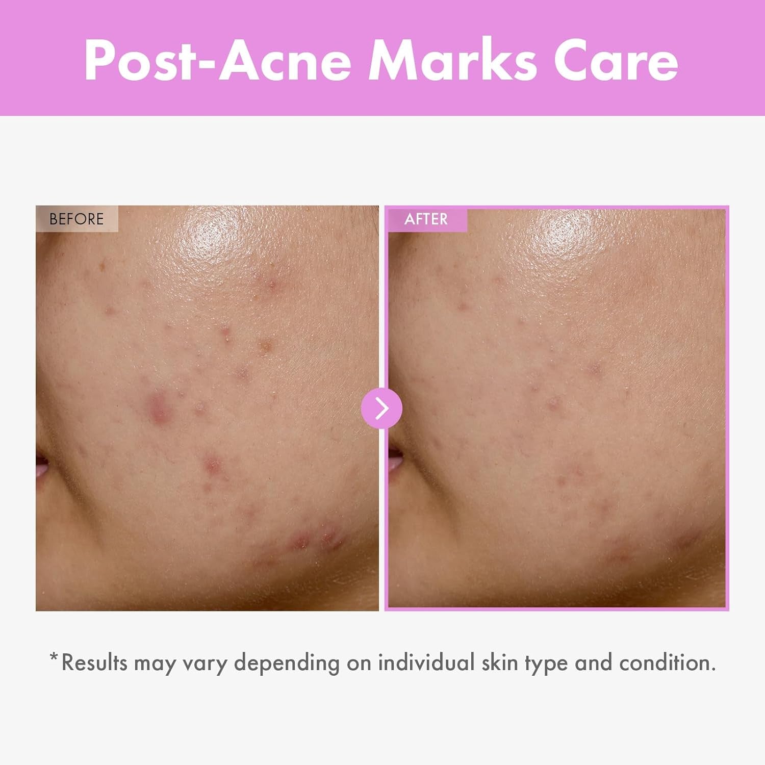 9 Peptide Skin Booster Serum, Niacinamide & Hyaluronic Acid Skin Renewal Boosting Facial Essence for All Skin Types, Korean Skin Care, Paraben Free, 150Ml, 5.07 Fl.Oz.