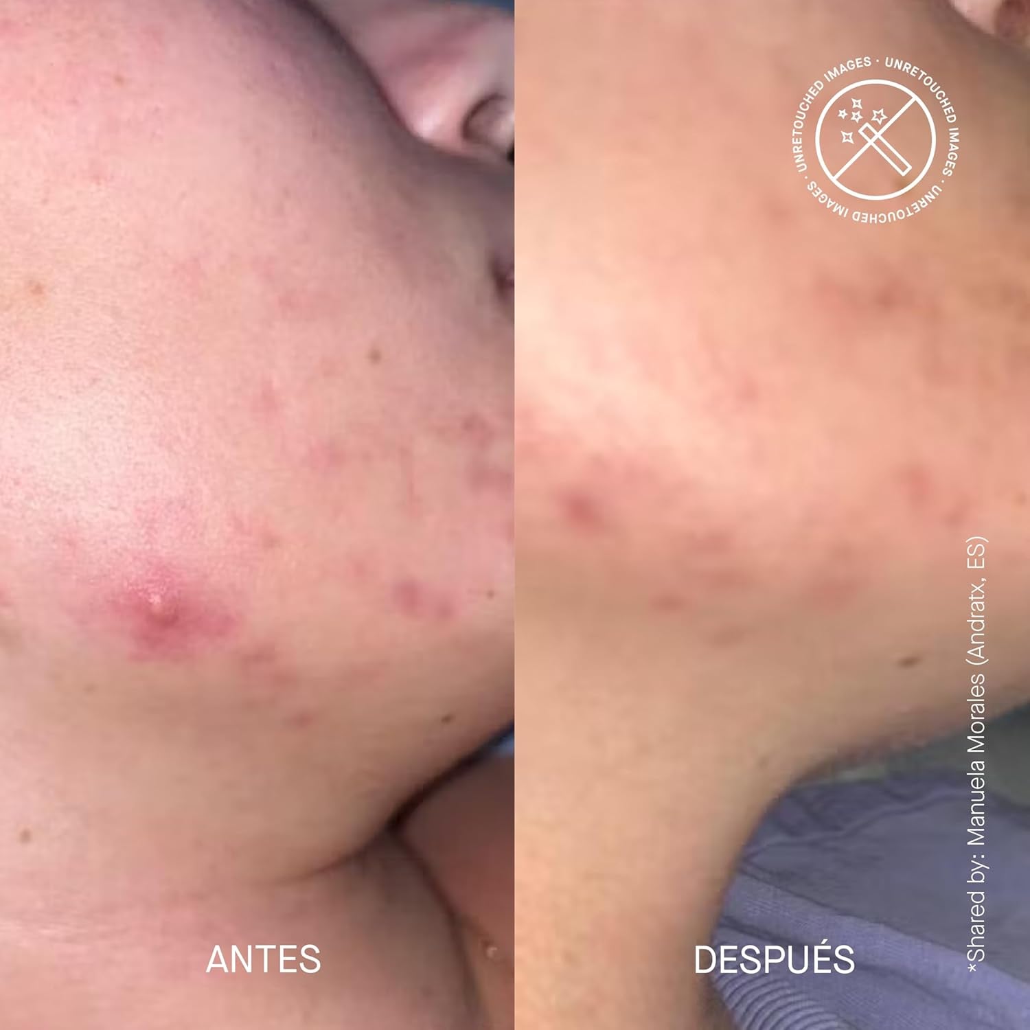 ZITCONTROL® - Treatment for Acne-Prone Skin