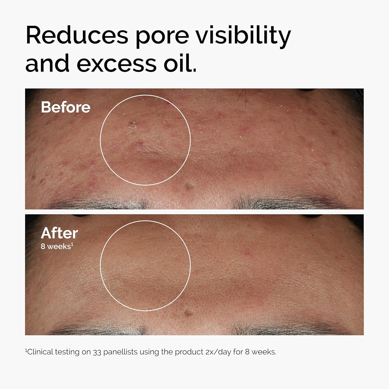 The Ordinary Niacinamide 10% + Zinc 1%, Brightening & Smoothing Serum for Blemish-Prone Skin, 30Ml